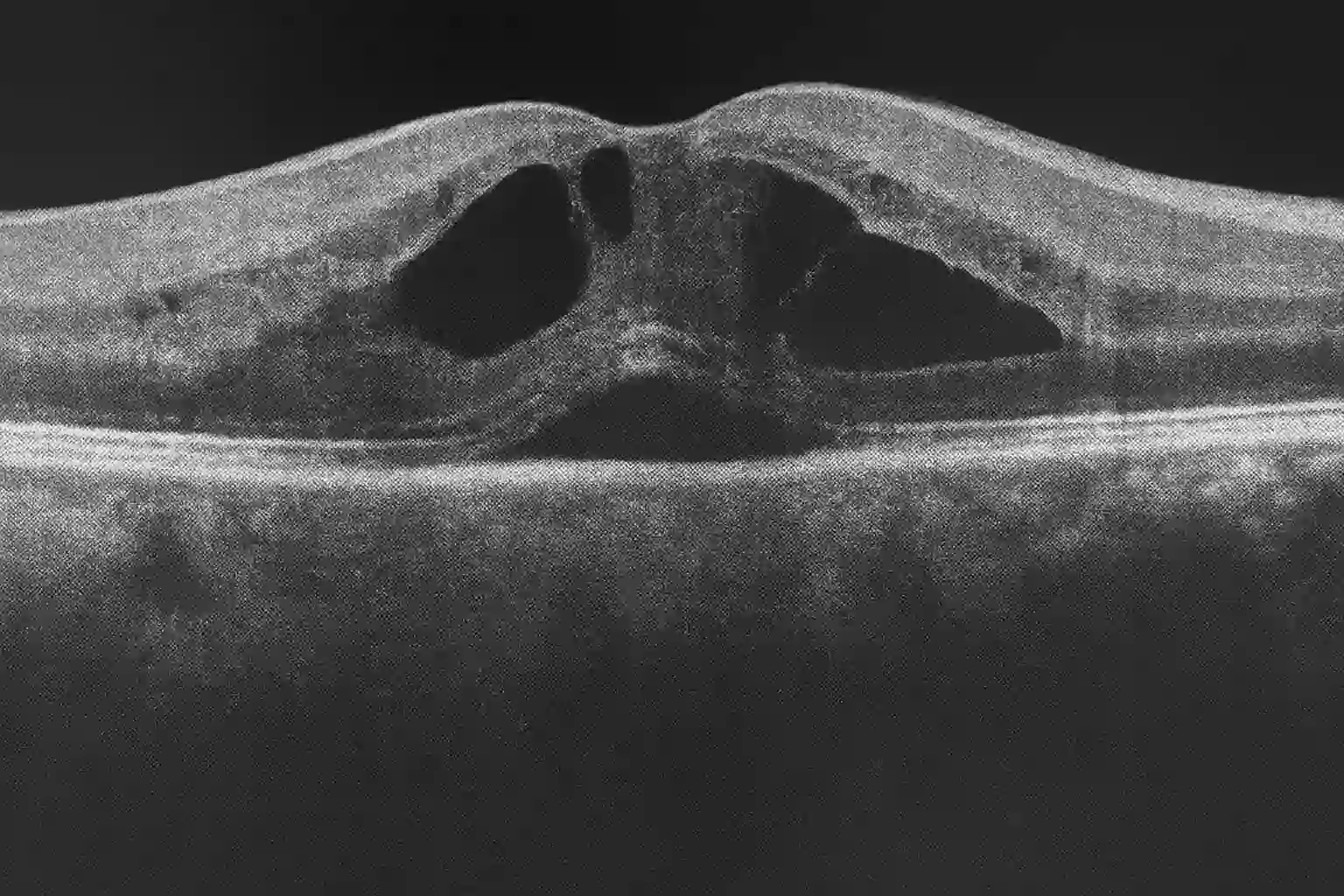 Edema Macular: Causas, Sintomas e Opções de Tratamento