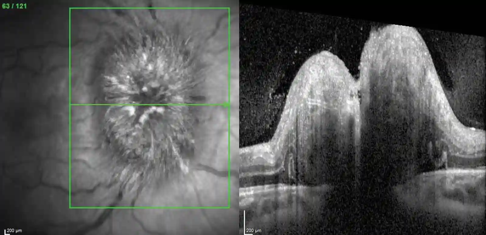 Papiledema: Quando o Inchaço do Nervo Óptico Sinaliza Problemas Graves