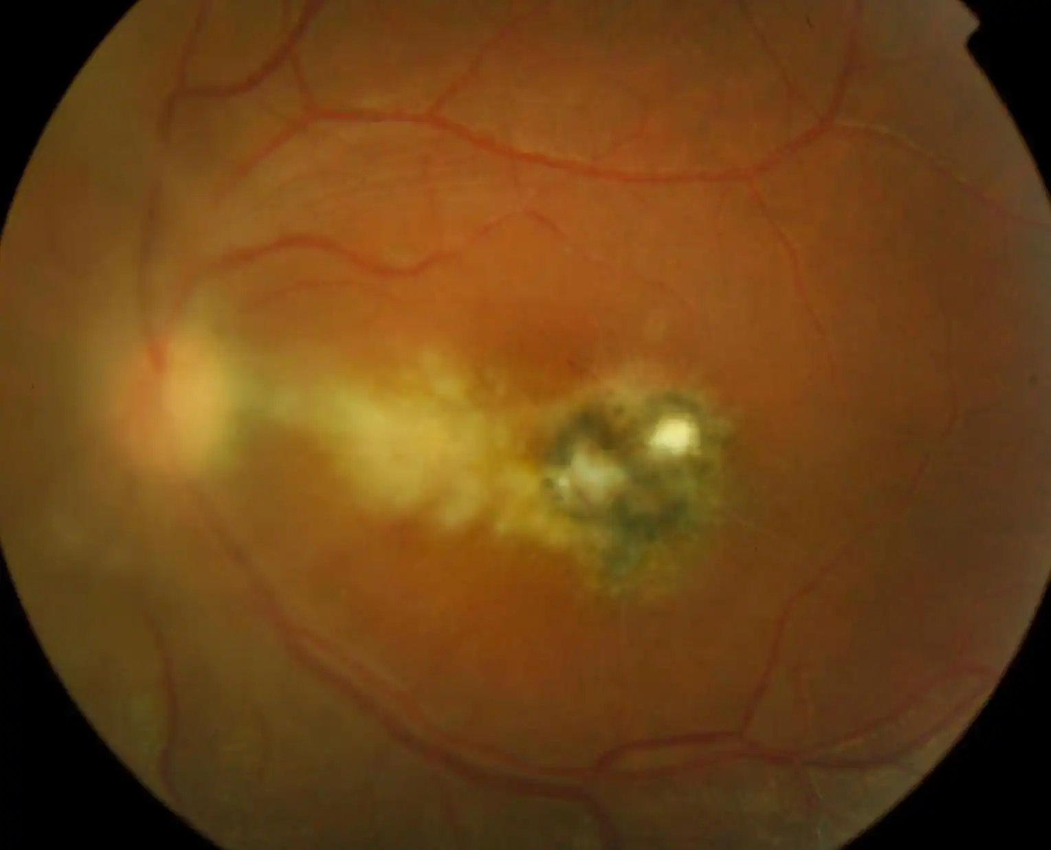 Quais Exames São Necessários para Diagnosticar Toxoplasmose Ocular?